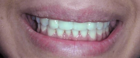 before after photo