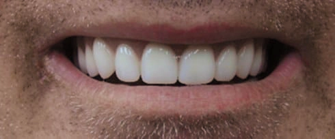 before after photo