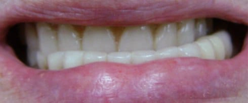 before after photo