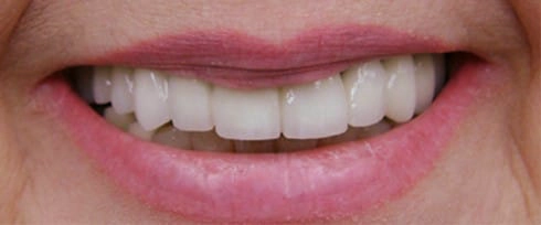 before after photo
