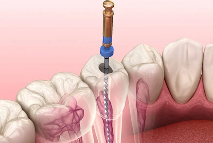 Root Canal Root Canal
