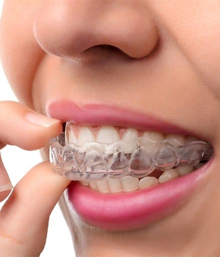 Invisalign Clear Braces Invisalign Clear Braces