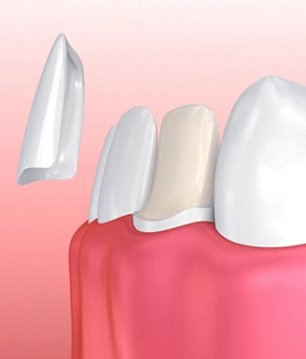Veneers veneers