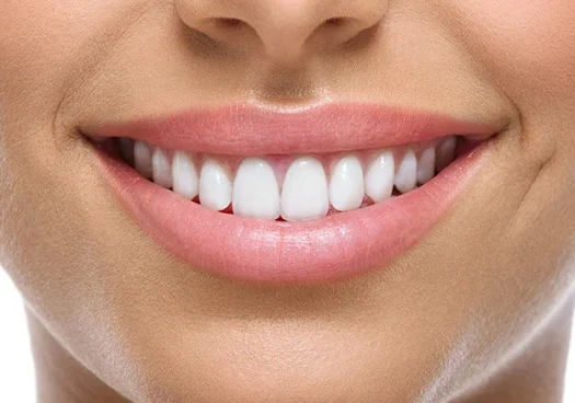 Teeth Whitening