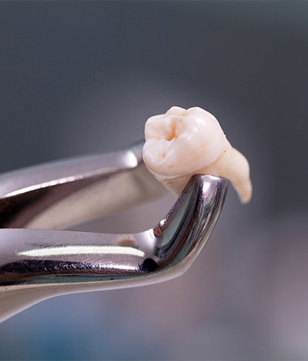 Wisdom Tooth Extractions Wisdom Tooth Extractions