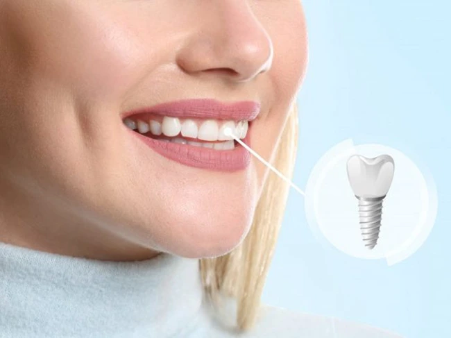 tooth decay tooth decay