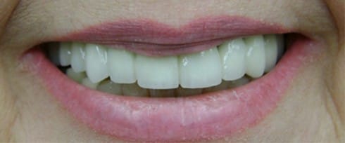 Smile after missing top teeth are replaced