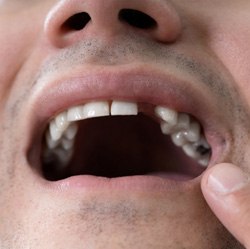 Dentist pointing to a dental implant model