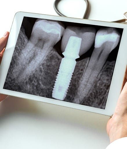 X-ray of dental implant supported dental crown