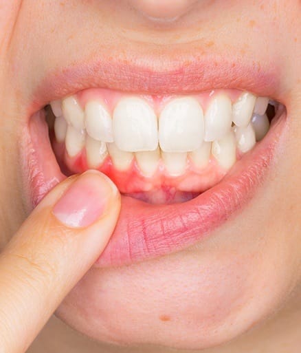 Closeup of damaged soft tissue due to gum disease