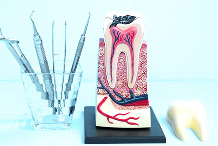 model of an infected tooth