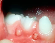 abscessed tooth drainage