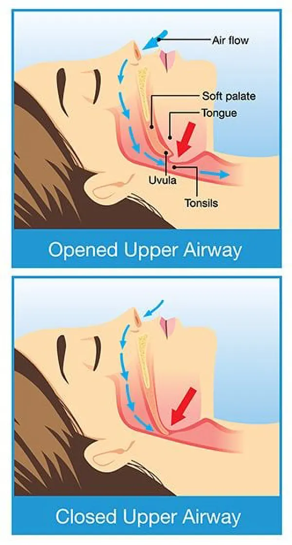 Sleep Apnea