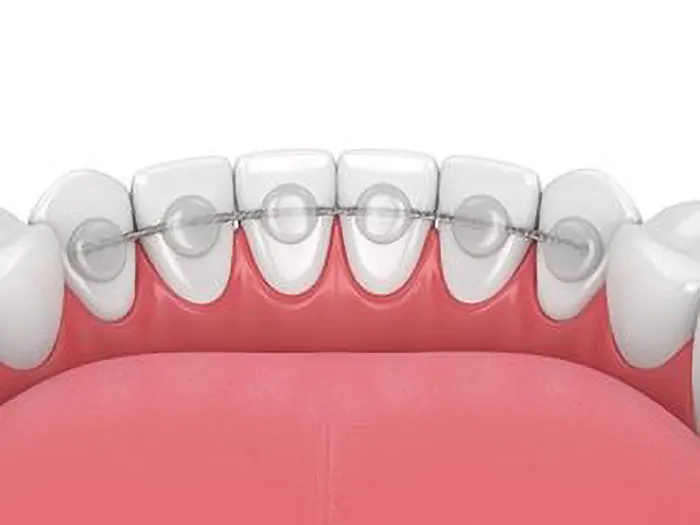 Fixed bonded retainer Fixed bonded retainer