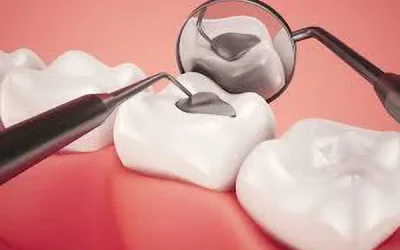 fillings