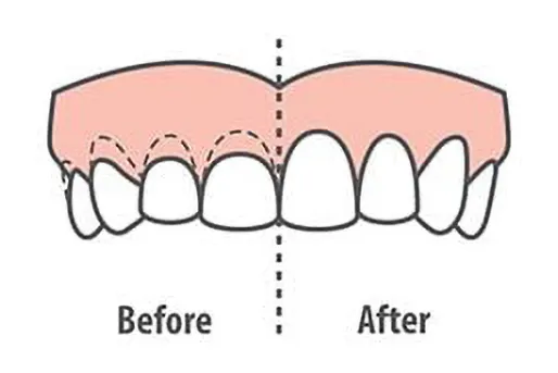 crown lengthening crown lengthening