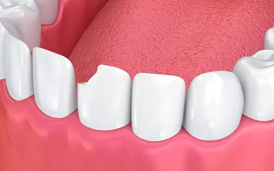 dental bonding