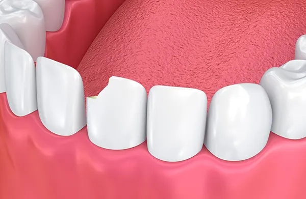 dental bonding dental bonding