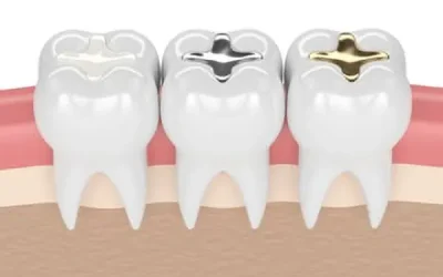 dental fillings