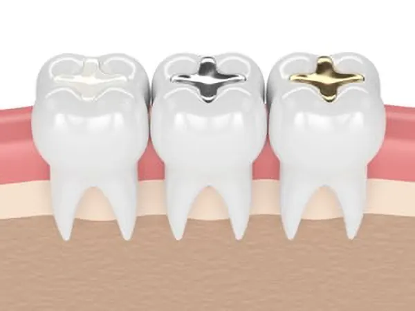 dental fillings dental fillings