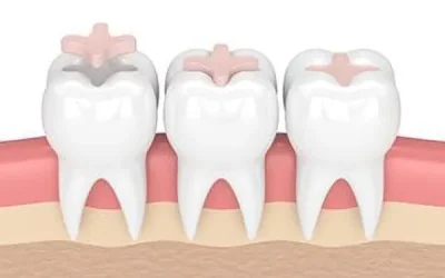 inlays dental web
