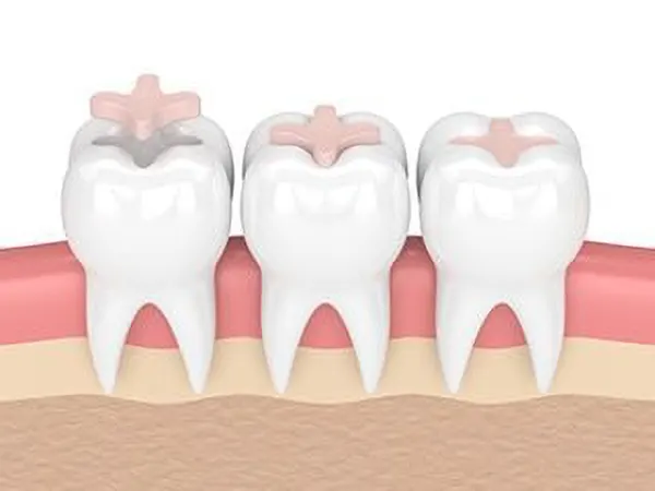 inlays dental web inlays dental web