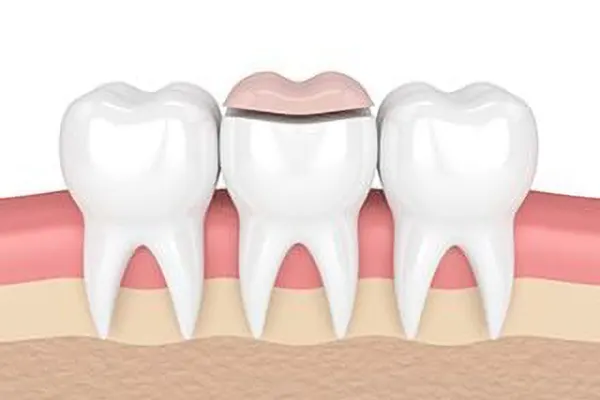 onlays dental onlays dental