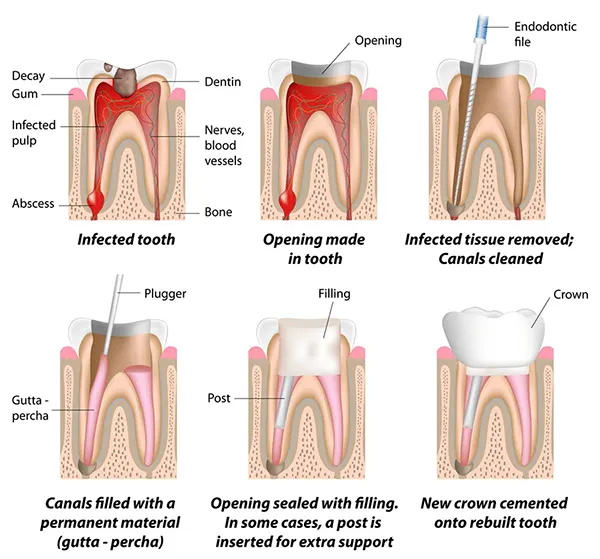 root-canal-treatment-web