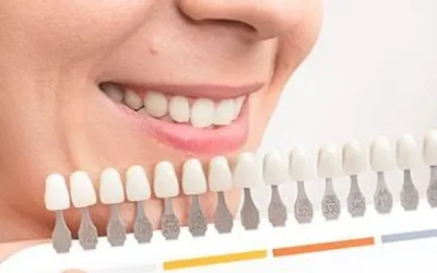 teeth whitening