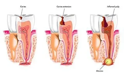 tooth decay prevention