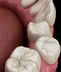 Invisalign