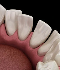 Invisalign