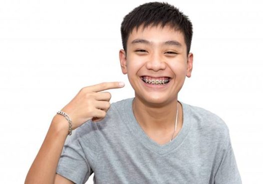 Traditional Braces