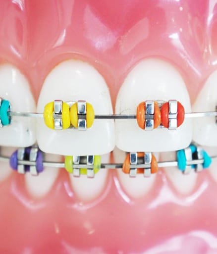 Traditional Braces-1