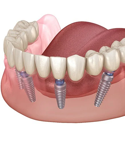 All on 4 Dental Implants