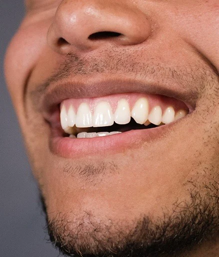 All on 4 Dental Implants