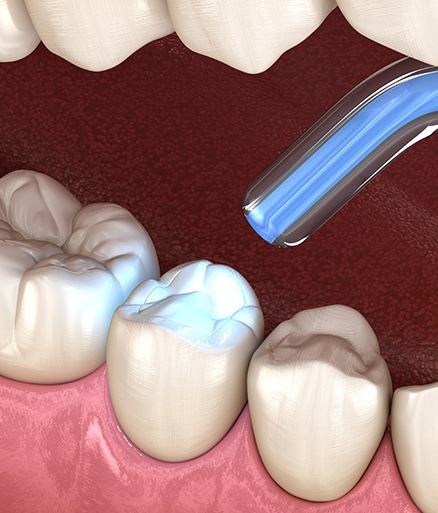dental bonding