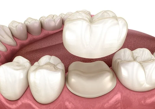 ceramic dental crowns ceramic dental crowns