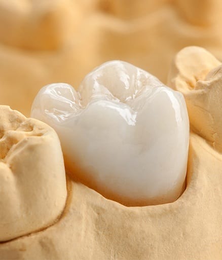 Dental Crowns