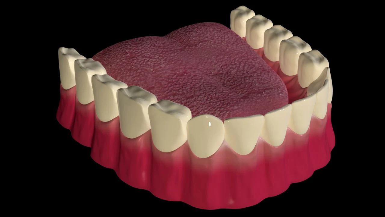 Dental Implants