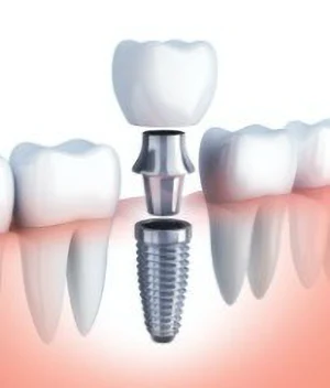 Dental Implants Dental Implants
