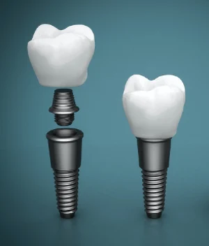 Dental Implants Dental Implants