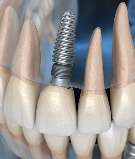 Dental Implants Dental Implants