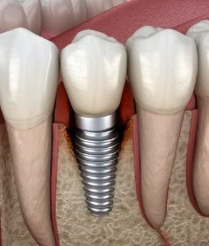 Dental Implants Dental Implants