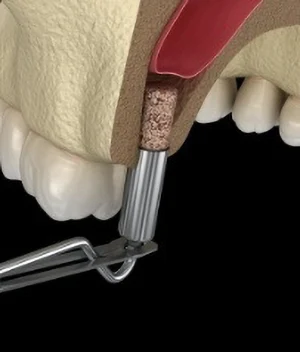 Dental Implants Dental Implants