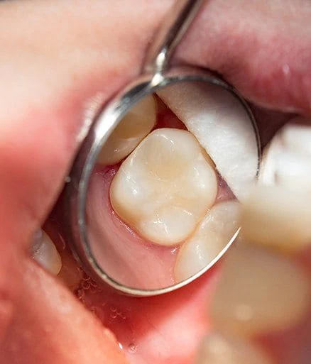 Tooth Colored Fillings Tooth Colored Fillings
