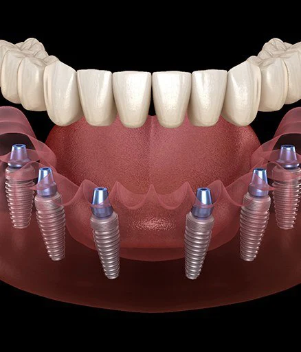 Implant Dentures