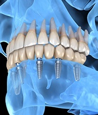 Implant Dentures