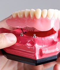 Implant Dentures