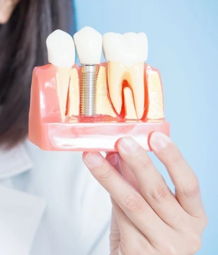 Dental Implants Dental Implants